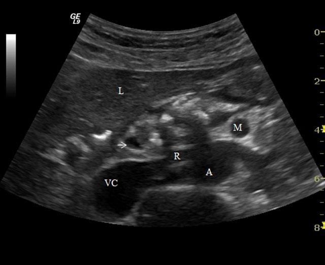 Figur 1:  Kronisk pankreatitt. Pankreas er atrofisk  med tallrike kalknedslag som kaster skygge. Lever (L), ductus choledochus (pil), vena renalis sinistra (R), arteria mesenterica superior (M), vena cava (VC) og aorta (A).