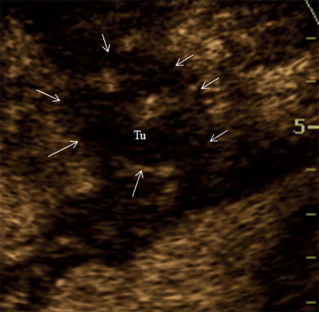 Figur 3:  Adenocarcinom i pankreas (CEUS). Kontrastforsterket ultralyd viser en typisk hypovaskulær (hypoekkoisk) tumor (Tu).  