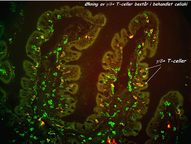 Figur 2. Eksempel på økningen av de intraepiteliale gamma/delta T-celler (gule TCRγ/δ+ T-celler, piler) ved diett- behandlet cøliaki. Dette cøliakispesifikke fenomenet står  selv etter langvarig GFD med fullstendig morfologisk normal-isering av tarmen. To-farget immunhistofluoresense farging for T-celler (CD3-grønn) og TCR γ/δ (rødt). 