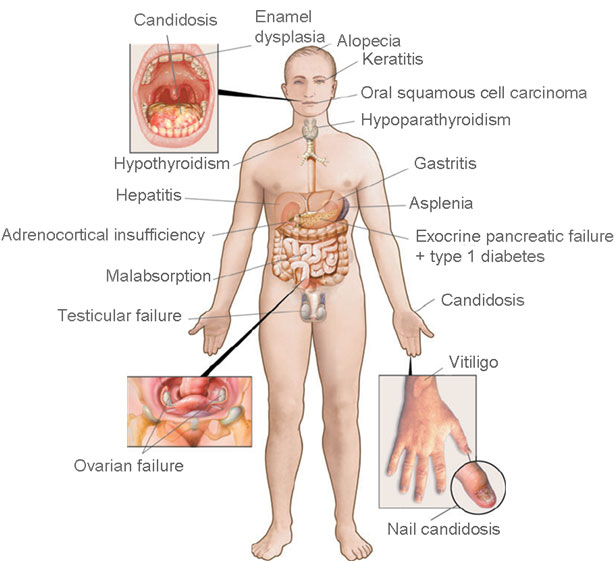 Figur 1. Homunculus med kliniske manifestasjoner