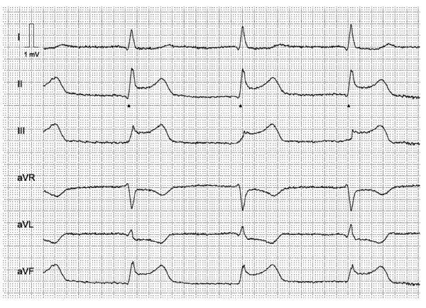 Figur 1. Typiske ST-elevasjoner hos pasient med akutt nedreveggsinfarkt.  EKG er tatt ca. en time etter smertedebut.