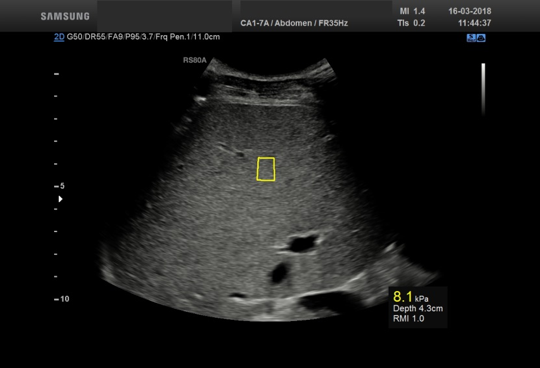 Bilde 4: Leverstivhetsmåling utført med pSWE fra Samsung RS80A med Prestige på samme pasient som i bilde 3. Den gule boksen viser måleområdet og er stedet for måling. Resultatet er angitt i kPa og vises i nedre høyre hjørne. 