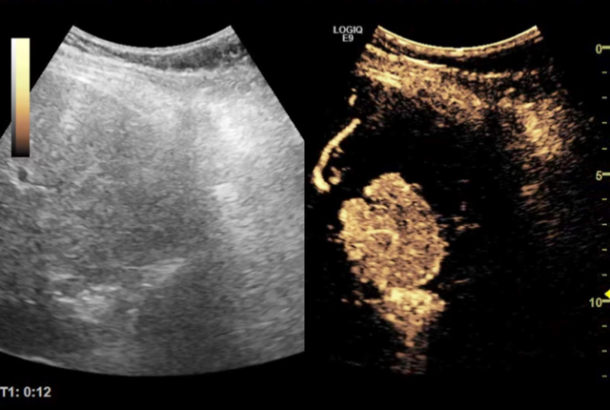 Bilde 5: Venstre: B-mode UL av lever. Høyre: Kontrastforsterket ultralyd med Sonazoid, som viser fokal nodal hyperplasi (FNH) i arteriefasen med rask oppladning, lenge før resten av det normale leverparenkymet.