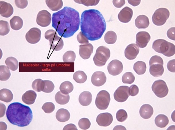 Figur 1: I blodutstryk ses 3 blaster. Disse kjennetegnes av glatt, ukondensert kjernekromatin, de har ofte tydelig nukleol (markert i en av cellene), og en sparsom basofil cytoplasmabrem. Foto: Mette Ekfelt Johansen/Hege Frøen.