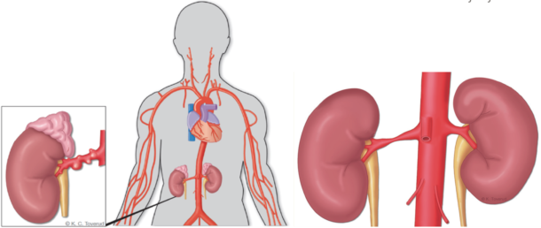 Figur 1: Fibromuskulær dysplasi (til venstre) kan i prinsippet affisere alle blodkar, men nyrearterier og halskar er predileksjonssteder. ­Aterosklerotisk nyrearteriestenose (til høyre) er ledd i generell aterosklerotisk sykdom og sitter ofte proksimalt i nyrearterien, til og med osteal.