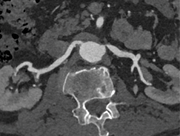 Figur 3: CT med kontrast i arteriell fase viser godt den proksimalt beliggende stenosen til venstre nyrearterie. Klinikk for bildediagnostikk, St. Olavs hospital