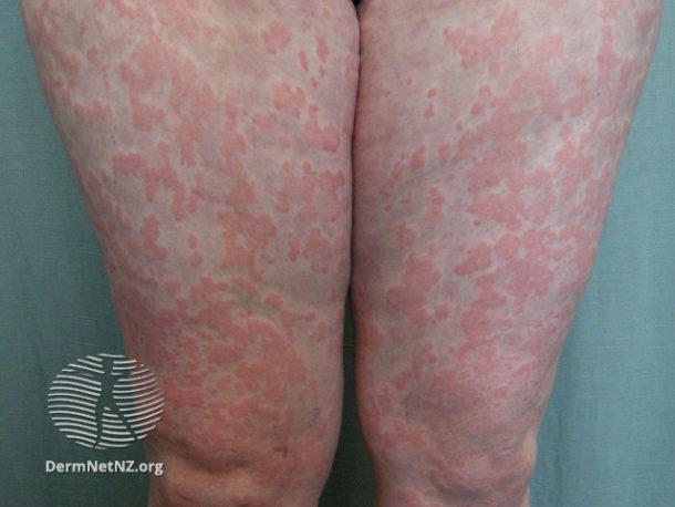 Bilde 1: I de fleste tilfeller med ­anafylaksi er hudmanifestasjoner tilstede, ofte i form av urtikaria. Foto ved ­www.dermnetnz.org