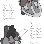 Figur 1. VES med opphav i ulike lokalisasjoner i hjertet, og ­tilhørende EKG-morfologier.