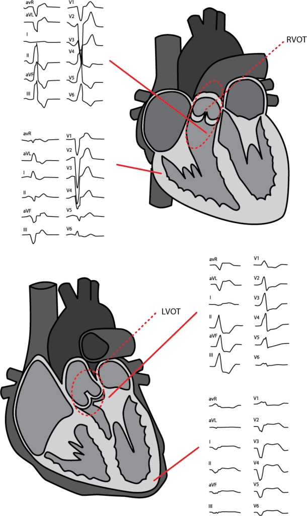 Figur 1. VES med opphav i ulike lokalisasjoner i hjertet, og ­tilhørende EKG-morfologier.