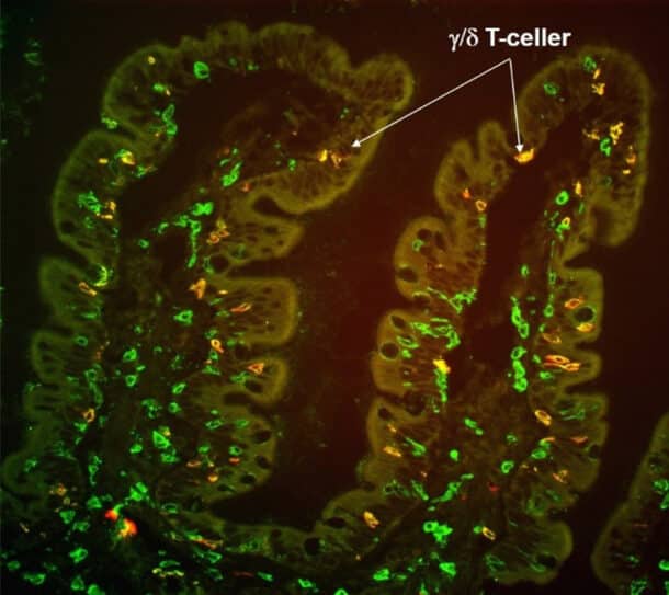 Figur 1: Snitt av duodenalslimhinne med økning av intraepiteliale gamma delta T-celler (farget gult). Denne pasienten hadde totter og marginalt forhøyet antall intraepiteliale (CD3+) T-celler (farget grønt), men med en klar økning av intraepitelial gamma-delta T-celler (piler, farget gult), noe som er karakteristisk for aktiv, potensiell og dietbehandlet cøliaki.