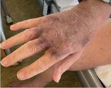 Bilde 2: Pasientfoto av høyre hånd som viser hvordan hud­blødningene strekker seg helt ned til håndryggen. Gjengitt med tillatelse. 