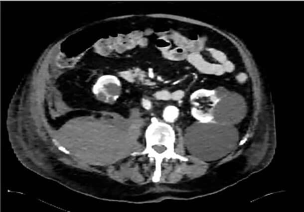 Bilde 4: CT snitt av abdomen som viser stort retroperi­tonealt hematom høyre side. Gjengitt med tillatelse.