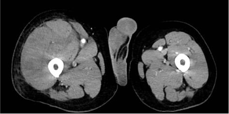 Bilde 3: CT snitt av lår som viser intramuskulært hematom i m.rectorus ­femoris høyre side med omkringliggende fettvevsreaksjon. Gjengitt med tillatelse.  