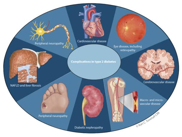 Figur 1. Metabolsk-assosiert steatotisk lever­sykdom som ledd i diabetes-komplika­sjoner.  Figur fra Tom H. Karlsen (idé) og Kari Toverud (tegning); ­trykket med tillatelse.