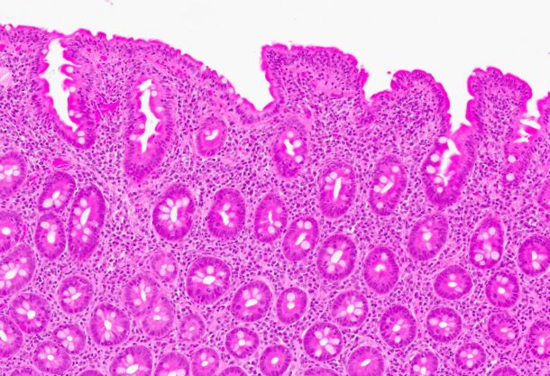 Bilde 1: (HES, 120x) Fra syk fase. Biopsi fra duodenum med uttalt ­totteatrofi, nærmest flat slimhinne. Blandet betennelsesinfiltrat i lamina propria (lymfocytter, plasmaceller, nøytrofile og eosinofile granulo­cytter) og økt antall lymfocytter i overflateepitelet. 
