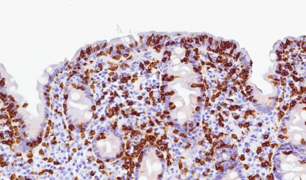 Bilde 2: (CD3, 300x) Fra syk fase. Immunhistokjemisk undersøkelse viser betydelig økt antall CD3-positive T-lymfocytter i overflateepitelet.