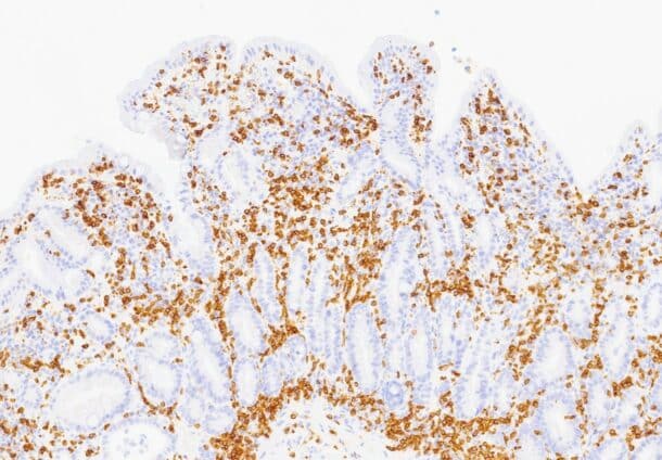 Bilde 5: (CD3, 100x) Fra syk fase. Immunhistokjemisk undersøkelse viser ikke økt antall CD3-positive T-lymfocytter i overflateepitelet. 