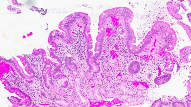 Bilde 6: (HES, 120x) Etter seponering. Biopsi fra duodenum (noe artefaktpreget med «hakk») med tilnærmet normale funn. Et mindre fokus gastrisk metaplasi i overflateepitelet (oppe til venstre).